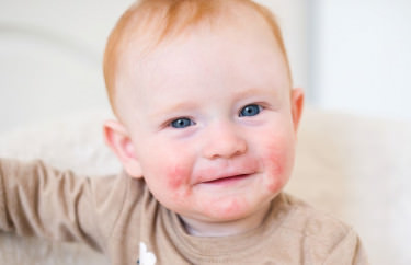 Atopowe zapalenie skóry u niemowląt - objawy, leczenie, kosmetyki, kremy