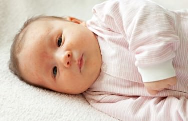 Wysypka u niemowlaka na twarzy i głowie - co może oznaczać, co robić?
